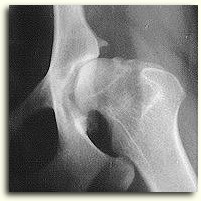 A dysplastic hip joint with degenerative joint disease.